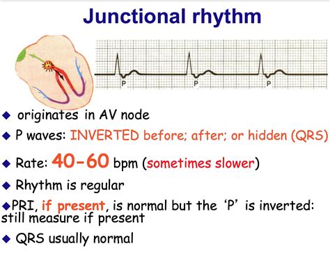 av junction box|junctional rhythm after ablation.